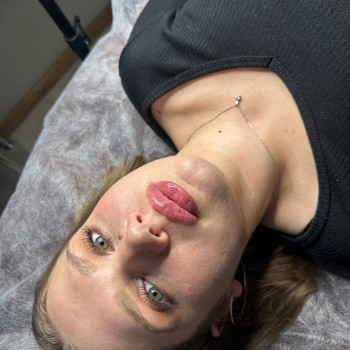 Контурна пластика губ
                    Косметолог-ін'єкціоніст Ольга Одеса