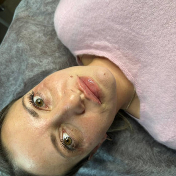 Контурна пластика губ
                    Косметолог-ін'єкціоніст Ольга Одеса