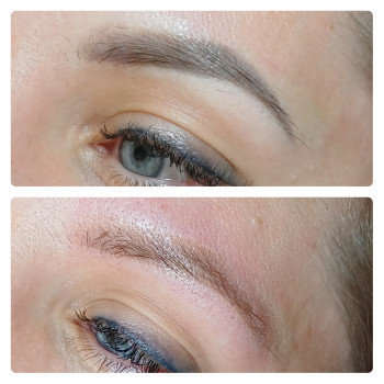 Після однієї процедури видалення