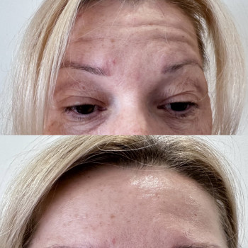 Ботулінотерапія верхньої третини обличчя.
  
 
 
 