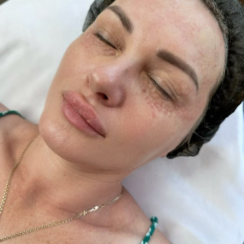 Біоревіталізація переорбітальної зони
 
 
 