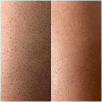 Гомілки, результат 8 процедур