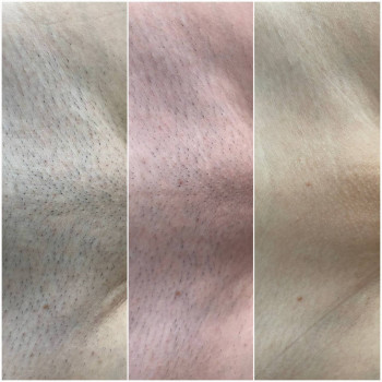 Лазерна епіляція на зоні бікіні - 7 процедур