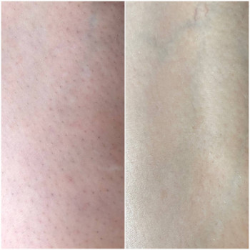 Гомілки, 7 процедур