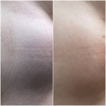 Зона бікіні, 6 процедур