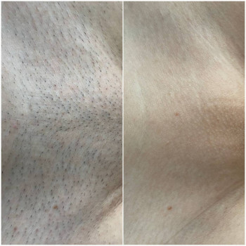 Зона бікіні, 5 процедур