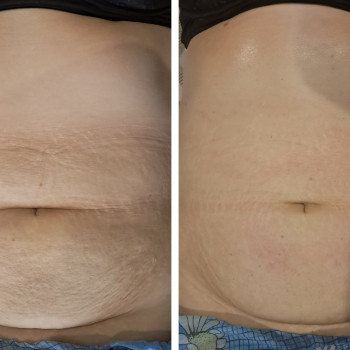 Рф ліфтинг тіла та обличчя
                    Масажист Людмила Полтава