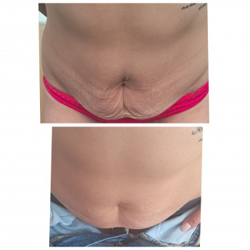 Рф ліфтинг тіла та обличчя
                    Масажист Людмила Полтава