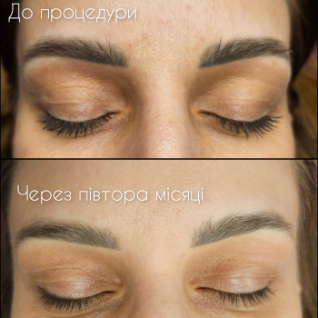 Удаление ремувером татуажа и тату
                    Мастер перманентного макияжа Наталя Харьков