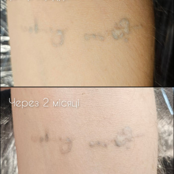 Удаление ремувером татуажа и тату
                    Мастер перманентного макияжа Наталя Харьков