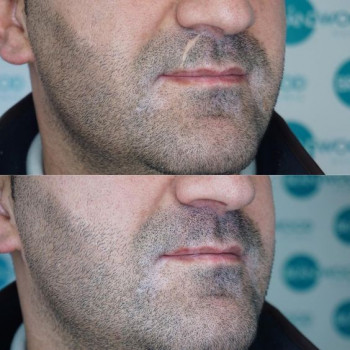 Трихопігментація
                    Майстер перманентного макіяжу Наталя Харків