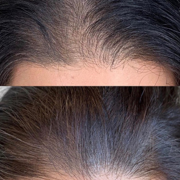 Трихопігментація
                    Майстер перманентного макіяжу Наталя Харків