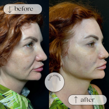 Смас ліфтинг нижня частина обличчя + підборіддя
                    Косметологический центр Safe Cosmo Kyiv Киев