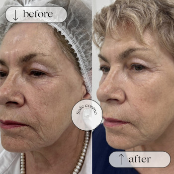 Смас ліфтинг нижня частина обличчя + підборіддя
                    Косметологический центр Safe Cosmo Kyiv Киев