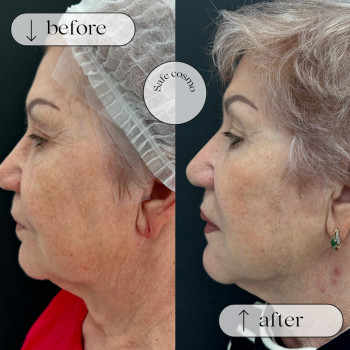 Смас ліфтинг нижня частина обличчя + підборіддя
                    Косметологический центр Safe Cosmo Kyiv Киев