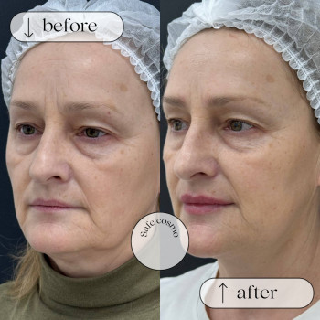 Смас ліфтинг нижня частина обличчя + підборіддя
                    Косметологический центр Safe Cosmo Kyiv Киев