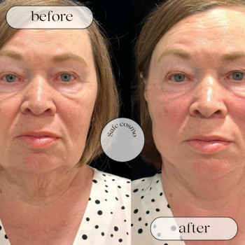 Смас ліфтинг нижня частина обличчя + підборіддя
                    Косметологический центр Safe Cosmo Kyiv Киев