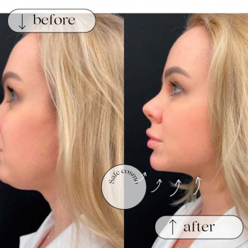 Смас ліфтинг нижня частина обличчя + підборіддя
                    Косметологический центр Safe Cosmo Kyiv Киев