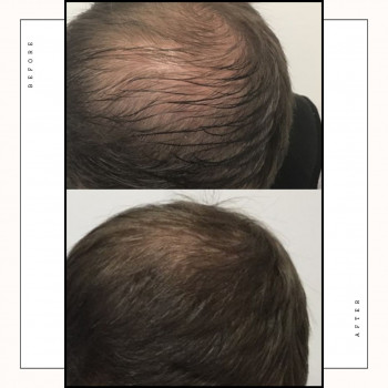 Трихопігментація
                    Косметологічний центр Safe Cosmo Kyiv Київ