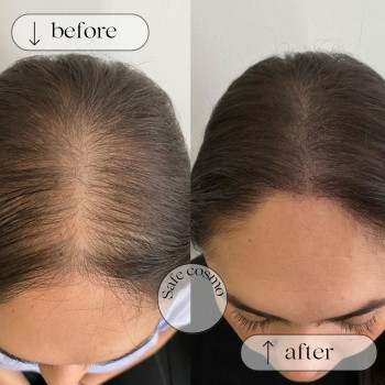 Трихопігментація
                    Косметологічний центр Safe Cosmo Kyiv Київ