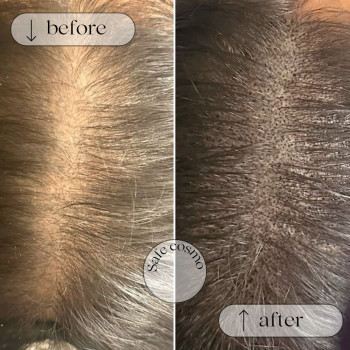 Трихопігментація
                    Косметологічний центр Safe Cosmo Kyiv Київ