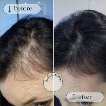 Трихопігментація
                    Косметологічний центр Safe Cosmo Kyiv Київ