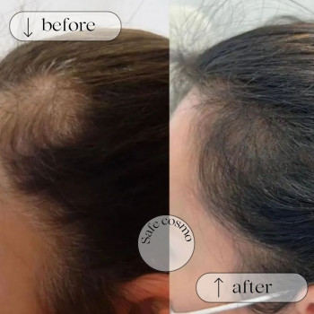 Трихопігментація
                    Косметологічний центр Safe Cosmo Kyiv Київ