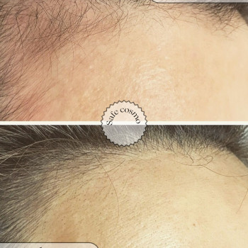 Трихопігментація
                    Косметологічний центр Safe Cosmo Kyiv Київ