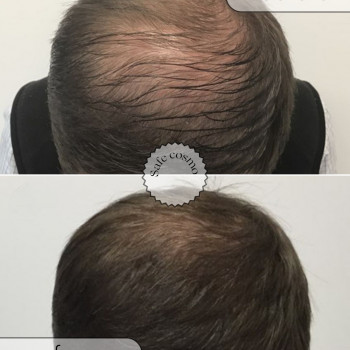 Трихопігментація
                    Косметологічний центр Safe Cosmo Kyiv Київ