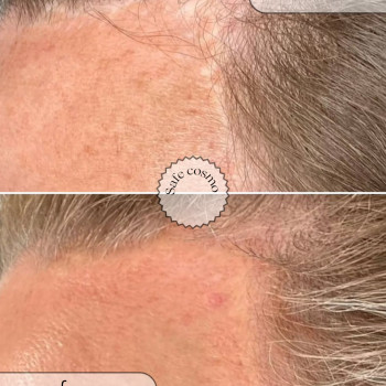 Трихопігментація
                    Косметологічний центр Safe Cosmo Kyiv Київ