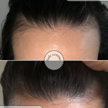 Трихопігментація
                    Косметологічний центр Safe Cosmo Kyiv Київ