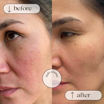 Полімолочний філер
                    Косметологический центр Safe Cosmo Kyiv Киев