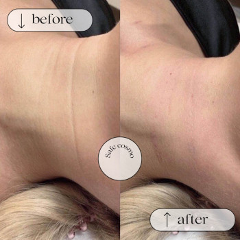 Полімолочний філер
                    Косметологический центр Safe Cosmo Kyiv Киев