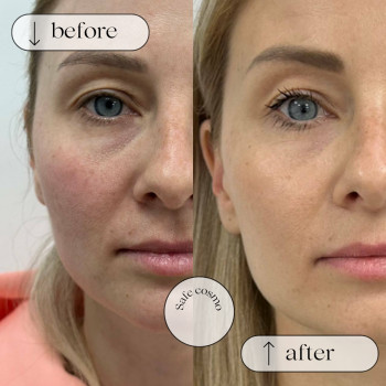 Полімолочний філер
                    Косметологический центр Safe Cosmo Kyiv Киев