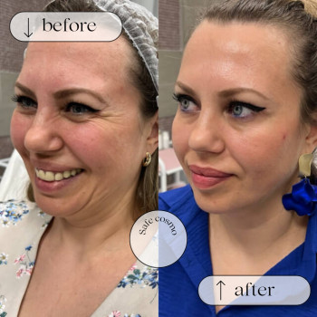 Ботулотоксин Нижня третина обличчя (губи, підборіддя,носогубка)
                    Косметологический центр Safe Cosmo Kyiv Киев