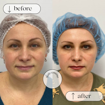 Ботулотоксин Нижня третина обличчя (губи, підборіддя,носогубка)
                    Косметологический центр Safe Cosmo Kyiv Киев