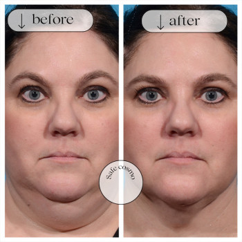 Ліполітики Непрямі
                    Косметологічний центр Safe Cosmo Kyiv Київ