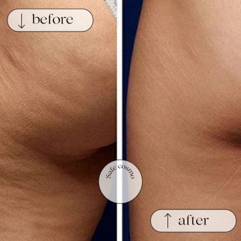 Ліполітики Прямі
                    Косметологічний центр Safe Cosmo Kyiv Київ