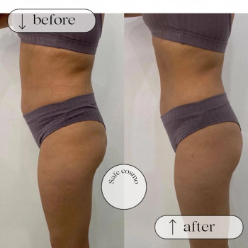 Ліполітики Прямі
                    Косметологічний центр Safe Cosmo Kyiv Київ