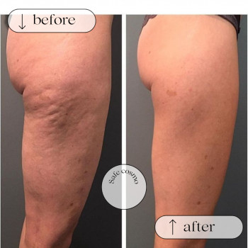 Ліполітики Прямі
                    Косметологічний центр Safe Cosmo Kyiv Київ