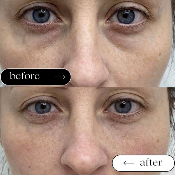 Мезотерапія Обличчя
                    Косметологический центр Safe Cosmo Kyiv Киев