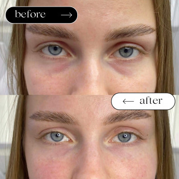 Мезотерапія Обличчя
                    Косметологический центр Safe Cosmo Kyiv Киев