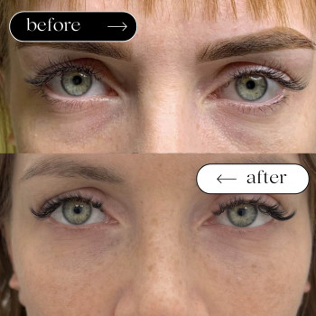 Мезотерапія Обличчя
                    Косметологический центр Safe Cosmo Kyiv Киев