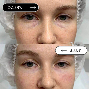 Мезотерапія Обличчя
                    Косметологический центр Safe Cosmo Kyiv Киев