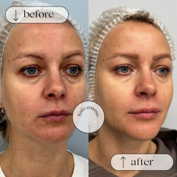 Біорепарація
                    Косметологический центр Safe Cosmo Kyiv Киев