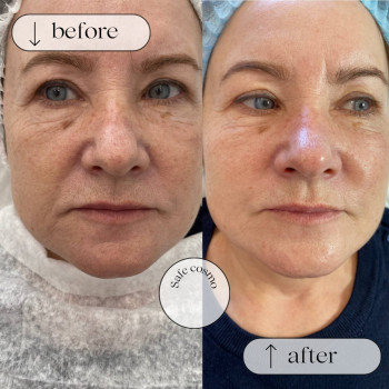 Біоармування
                    Косметологический центр Safe Cosmo Kyiv Киев