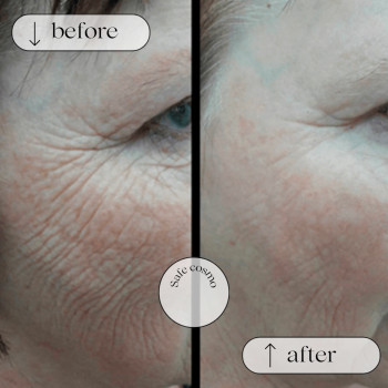 Біоармування
                    Косметологический центр Safe Cosmo Kyiv Киев