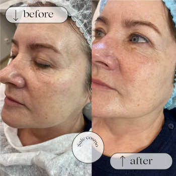 Біоармування
                    Косметологический центр Safe Cosmo Kyiv Киев