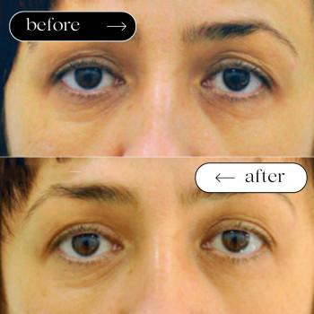 Полімолочна кислота Hydro PLLA
                    Косметологічний центр Safe Cosmo Kyiv Київ