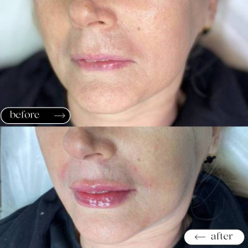 Збільшення губ
                    Косметологический центр Safe Cosmo Kyiv Киев